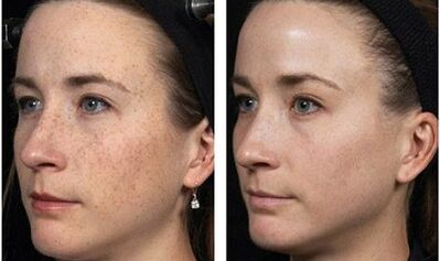 rejuvenecimiento facial fraccionado fotos antes y después