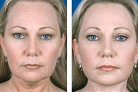 Antes y después del rejuvenecimiento facial con láser.